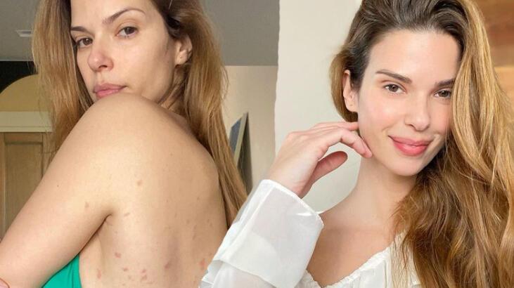 Larissa Gacemer hastalığını açıkladı