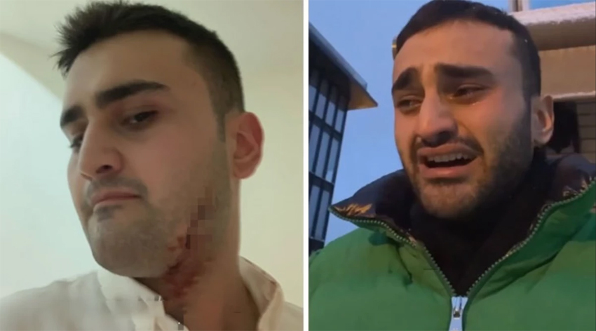 CZN Burak'ın vücudu kesikler içinde!